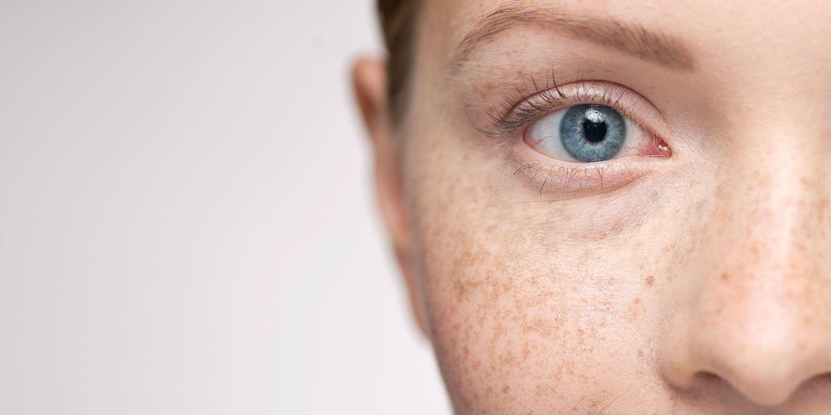 Freckles Skin Pigmentation