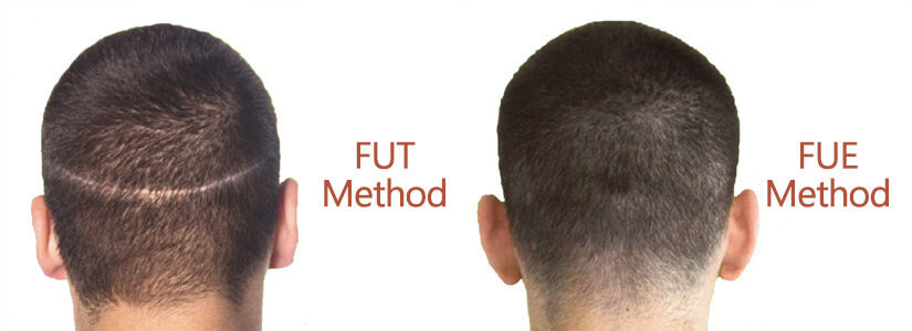 best-hair-transplant-clinic-in-lucknow​